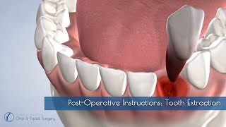 PostOperative Instructions Tooth Extraction [upl. by Adala436]