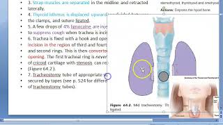 NEJM Procedure Thrombus Aspiration [upl. by Akimrehs]