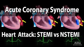 Acute Coronary Syndrome Unstable Angina NSTEMI and STEMI Heart Attack Animation [upl. by Aisetra216]