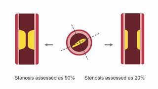 Assessing Lesion Severity in Coronary Angiography [upl. by Lepine784]