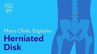 Mayo Clinic Explains Herniated Disk [upl. by Jenine]