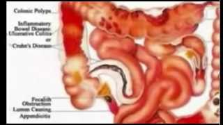 The Shocking Truth About Colon Hydrotherapy [upl. by Patric240]