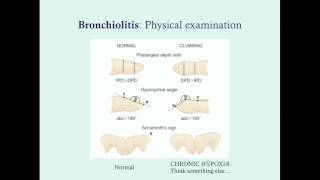 Bronchiolitis treatment  Respiratory system diseases  NCLEXRN  Khan Academy [upl. by Ransell]