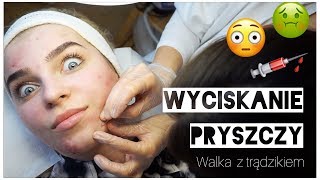 WYCISKANIE PRYSZCZY 😱💉 walka z trądzikiem 💪 [upl. by Gabbey]