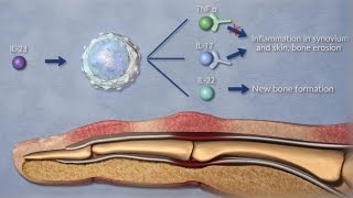 Psoriatic Arthritis  3D Medical Animation [upl. by Freedman]