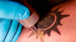 How Laser Tattoo Removal Works  Smarter Every Day 123 [upl. by Senecal110]