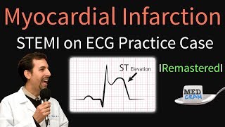 Myocardial Infarction  STEMI on ECG  Practice EKG [upl. by Anaiuq]