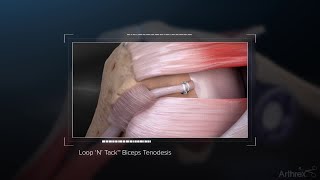 Loop ‘N’ Tack™ Biceps Tenodesis [upl. by Odawa]