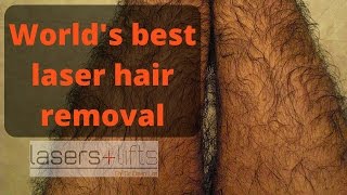 Worlds best hair removal laser [upl. by Otsirave]