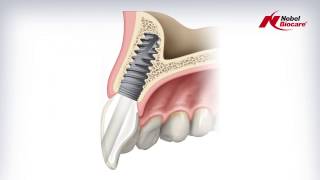 Angulated Screw Channel ASC Abutment [upl. by Adniled]