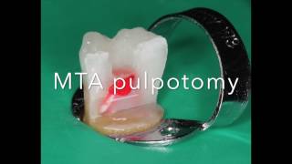 MTA pulpotomy step by step by Jorge Casián Adem [upl. by Danella]