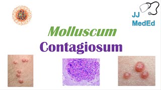 Molluscum Contagiosum “Papules with Belly Buttons” Risk factors Symptoms Diagnosis Treatment [upl. by Itoc]