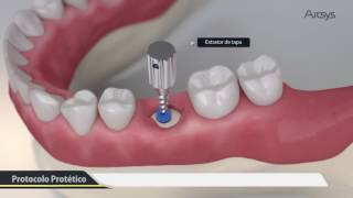 Procedimento Cirúrgico 3D  Arcsys Sistema de Implantes  FGM [upl. by Edorej]