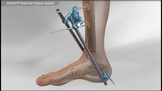 ArthroFX® External Fixation System [upl. by Vinny]