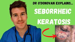 Explaining Seborrheic Keratosis  With Dr ODonovan [upl. by Strickler312]