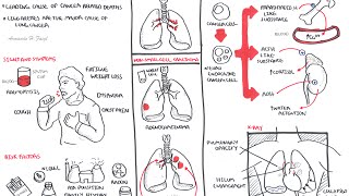 Lung Cancer  Overview [upl. by Dnomhcir]