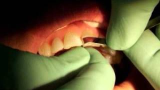 IPR for Invisalign Patients [upl. by Sailesh174]