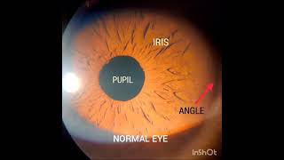 Laser Peripheral Iridotomy for Angle closure glaucoma [upl. by Gregorio]