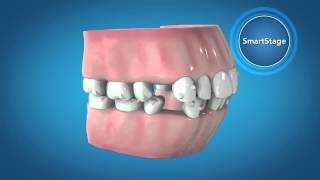 Invisalign G6 Innovations for First Premolar Extraction [upl. by Neumark]