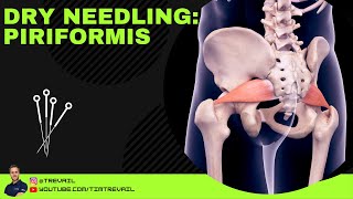 Dry Needling Piriformis [upl. by Bryna]