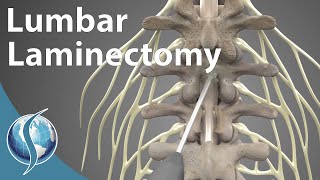 Lumbar Laminectomy [upl. by Siryt]