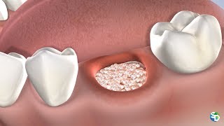 Socket Preservation After Tooth Extraction  San Diego CA [upl. by Yenterb]