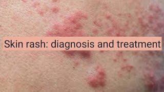 Skin Rash diagnosis and treatment [upl. by Merrili]