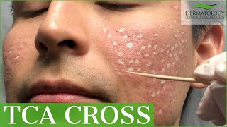 Acne Scar Removal with TCA Cross 80  Los Angeles  Dr Ben Behnam [upl. by Joeann711]