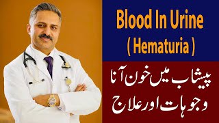 Blood in Urine  Hematuria  Causes amp Treatment [upl. by Greabe]