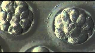 5Day Blastocyst Transfer [upl. by Ahsienar]