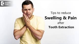 How to manage swelling amp pain post tooth extraction  Dr Chandan Mahesh [upl. by Lebasile]