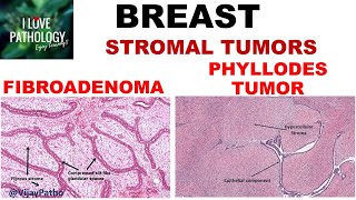 Diseases of Breast Part 3 Fibroadenoma amp Phyllodes tumor [upl. by Arva]