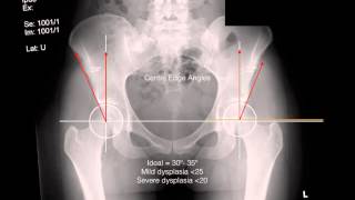 dysplasia xrays [upl. by Boyes503]