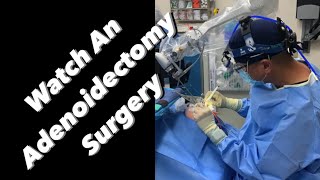 Adenoidectomy  actual footage [upl. by Ijar]