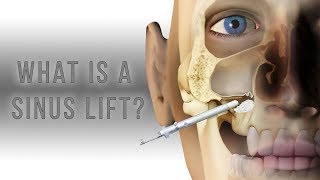 What is a sinus lift [upl. by Yeldarb195]