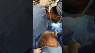 Liposuction Sculpting vs Fat Removal [upl. by Sheff]