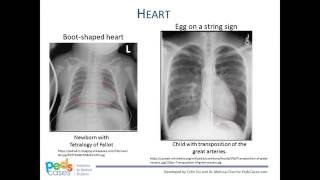 Approach to Pediatric Chest XRays [upl. by Einnig695]