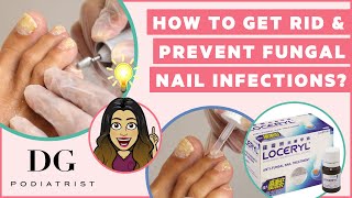 How to get rid and prevent toenail fungus [upl. by Petie]