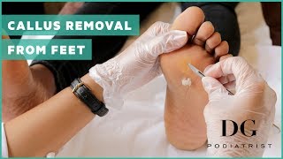 Callus removal from feet balls of feet [upl. by Ammeg]