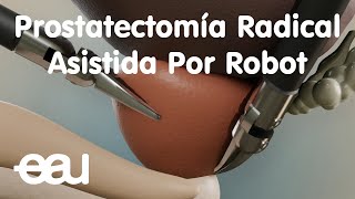 Prostatectomía Radical Asistida Por Robot [upl. by Deppy]