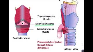 ESOPHAGEAL DIVERTICULUM [upl. by Rosena]