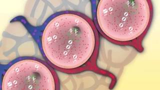 Acute Bronchiolitis Bronchiolitis ObliteransOrganizing Pneumonia BOOP  Pulmonology [upl. by Krasnoff]