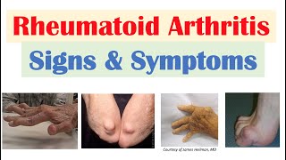 Rheumatoid Arthritis RA Signs amp Symptoms amp Associated Complications [upl. by Steinway]