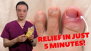 6 HOME REMEDIES To Treat A PAINFUL Ingrown Nail  Dr Kim [upl. by Divadnoj]