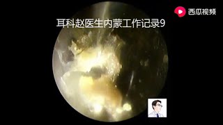 Cleaning cholesteatoma of external auditory canal and tympanic enucleation with otoendoscopy [upl. by Kamaria723]