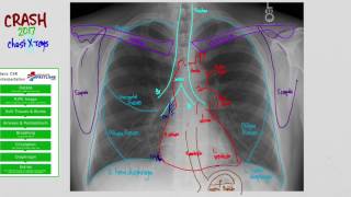 01 CXR Anatomy [upl. by Inami]