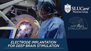 How Do They Implant The Electrode For Deep Brain Stimulation [upl. by Mairam]