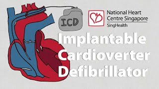 What is an Implantable CardioverterDefibrillator ICD  What to Expect [upl. by Chatav]