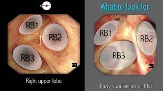 Mastering Bronchoscopy for Thoracic Surgery Chapter 2 [upl. by Nora364]