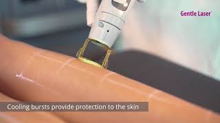 Laser Hair Removal  Candela GentleMax Pro [upl. by Yknarf]